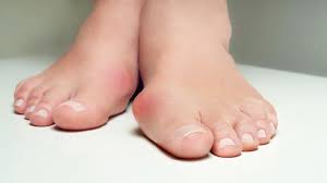 Fussfehlstellung Hallux Valgus Was Hilft Life Goes On Tv