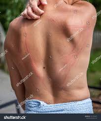 Image result for Dermatographism