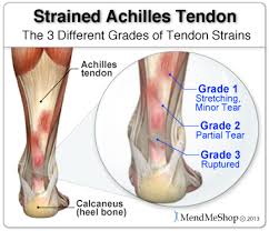 Pin On Achilles Recovery