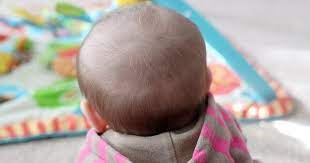 How To Prevent A Bald Spot From Developing On The Back Of A Baby S Head Baby Hair Loss Baby Losing Hair Baby Hair Falling Out