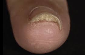 Image result for Pitting nails feet