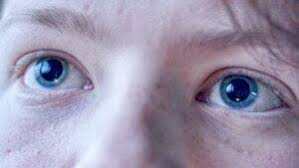 Image result for Mydriasis