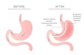 gastric sleeve surgery certified