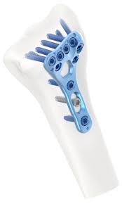 Volar Distal Radius Fixation Plating System | tradekorea