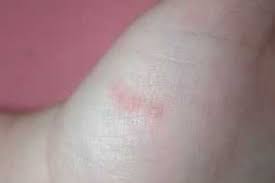 Image result for scabies human bites