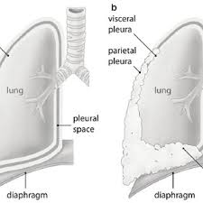 Signs and symptoms may include shortness of breath due to fluid around the lung, chest pain, cough, and fatigue. Malignant Pleural Mesothelioma Vs Normal Pleura A Normal Pleura Download Scientific Diagram