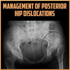Image result for Hip Dislocation