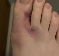 Maybe you would like to learn more about one of these? Doctor With Suspected Broken Big Toe Mumsnet