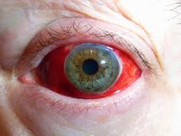 I've got these really bloodshot eyes. Bloodshot Eye Bloodshot Eyes Bloodshot Eyes