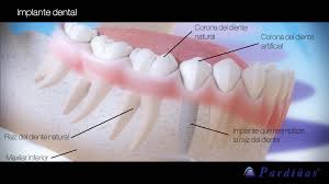 Partial dentures often have some form of clasp that attaches to your natural teeth and can easily be taken out of your mouth for cleaning or storing while you sleep. Indications And Contraindications Of Dental Implants Pardinas Dental Medical Clinic Clinica Pardinas
