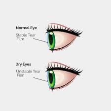 Image result for Dry Eye