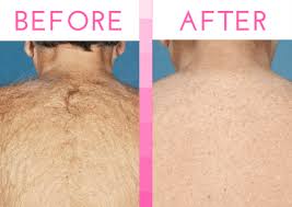 Laser hair removal is the process of hair removal by means of exposure to pulses of laser light that destroy the hair follicle. Laser Hair Removal Services At National Laser Institute