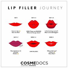Since fillers are now used in so many kinds of aesthetic treatments, such as the filling of wrinkles, the correction of asymmetries or scarring, volume replacement, contouring, and rejuvenation. Lip Fillers Before And After A Transformation For The Better