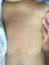 Maybe you would like to learn more about one of these? 1 Secret To Understanding House Dust Mites Allergy And 6 Proven Ways To Combat It Project Simplicity