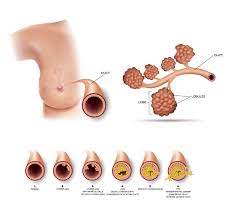 But where did it come from? Breast Cancer Overview Fort Lauderdale Fl Dr Burgers