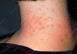 Contact Dermatitis Caused By Necklace Stock Image M320 0245 Science Photo Library