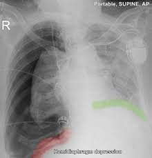 Maybe you would like to learn more about one of these? Tension Pneumothorax Radiology Reference Article Radiopaedia Org