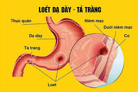 Ngoài những thực phẩm nên ăn, người bị đau dạ dày cũng nên lưu ý mà tốt nhất nha mấy anh đã bị dạ dày rồi thì phải kiêng cái mồm cái miệng đi cứ uống rượu bia thì làm gì có thuốc nào điều trị được ak, nguyên tắc khi điều trị bệnh là dù đông hay. Cháº¿ Ä'á»™ Äƒn Cho NgÆ°á»i Bá»‹ Viem Loet Dáº¡ Day Ta Trang