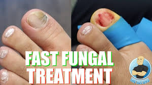 Bioclear Nail Fungus Pen Reviews The Fastest Way To Treat Toenail Fungus Youtube