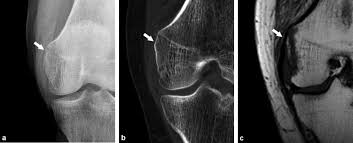 The cause of the knee effusion is unknown. Acute Traumatic Knee Radiographs Beware Of Lesions Of Little Expression But Of Great Significance Sciencedirect