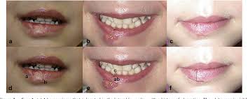 They can be treated with electrodessication, liquid nitrogen or laser. Figure 3 From Management Of Lip Hemangiomas Minimizing Peri Oral Scars Semantic Scholar