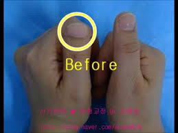 I myself am half irish, 3/8 german, 1/8 polish. Clubbed Thumbs Brachydactyly Youtube
