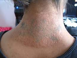 The sessions required for the tattoo removal also depend on the color of the ink, the intensity of the ink, and the amount of the ink. Which Is The Best Tattoo Removal Method