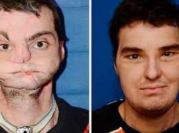 Trasplante exitoso de cara demuestra cuanto a avanzado la medicina: Eric  Santamaría