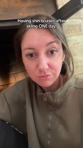 Is It Normal for My Shin to Bruise While Using A Boot