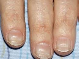 Horizontal ridges, also called beau's lines, are abnormalities of the nail plate that appear as rumpling from the base to the tips of nails and are characterized by poor nail structure of both fingernails and toenails. Beau S Lines Medicalopedia