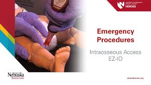 Image result for Intraosseous Access