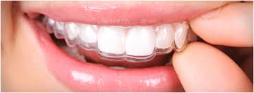 Here is the cost breakdown for different types of retainers: Retainers Odl Dental Clinic Orthodontics Affordable Braces London