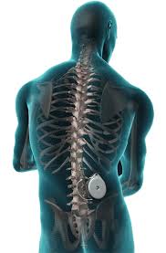 Image result for Intrathecal Pump