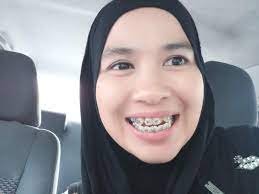 Check spelling or type a new query. Yat S Braces Journey Pengalaman Pemasangan Braces Hayatisuki