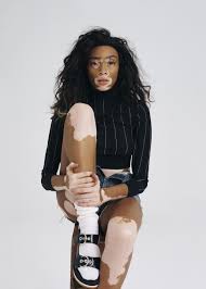 Winnie Harlow In Grazia Uk Nov 28th 2016 By Mark Rabadan Winnie Harlow Vitiligo Model Grazia Uk