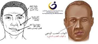 From wikipedia, the free encyclopedia. Ø§Ù„Ø¹ØµØ¨ Ø§Ù„Ø³Ø§Ø¨Ø¹ Ù…Ø±ÙƒØ² Ø§Ù„Ø´Ø±ÙˆÙ‚ Ù„Ù„Ø¹Ù„Ø§Ø¬ Ø§Ù„Ø·Ø¨ÙŠØ¹ÙŠ Ùˆ Ø§Ù„ØªØ£Ù‡ÙŠÙ„ Ø·Ø¨Ø±Ø¨ÙˆØ± ÙÙŠØ³Ø¨ÙˆÙƒ