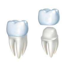 In our practice where a majority of patients do not have dental insurance we charge rs. Understanding The Cost Of Same Day Crowns In Boiling Springs