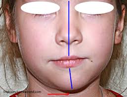 Hypoplasie du condyle gauche chez un enfant de 7 ans/orthodontiste Québec