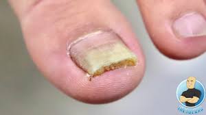 It is also important to look at melanoma pictures of toenails. Is This Toenail Fungus Learn All About Nail Fungus Treatment Must Watch Youtube