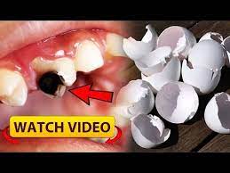 Nothing But Eggshells You Can Get Rid Of Tooth Cavities Like Magic Youtube In 2021 Tooth Cavity Heal Cavities Healthy Teeth