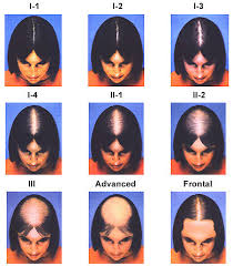 See more ideas about hair loss, hair loss treatments, hair loss treatment. Female Hair Loss Treatment Modena Hair Institute