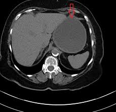 Endometrial cancer may develop in breast cancer patients who have been treated with tamoxifen. Cureus Unusual Presentation Of Gastric Outlet Obstruction Due To Breast Cancer Metastasis A Case Report