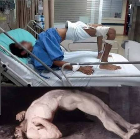 الكزاز* هو مرض غير معدي تتم الإصابة به من خلال التعرض للجراثيم البكتيرية والمطثية الكزازية التي توجد في جميع أنحاء العالم في التربة وفي أجهزة الأمعاء الحيوانية، وعلى هذا النحو يمكن أن