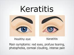 Why You Need To Take Your Contacts Off Before Going To Bed Downtown Eyes