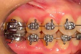 Check spelling or type a new query. Braces And Cavities Orthodontics In London