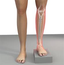 Image result for Functional Leg Length Discrepancy