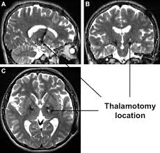 Image result for Thalamotomy