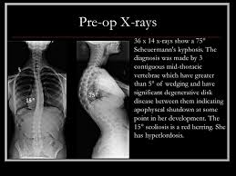 Scheuermann's disease is a thoracic or thoracolumbar hyperkyphosisdue to wedged vertebrae developing during adolescence. Case Review 9 19 Year Old Female With Scheuermann S Disease