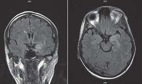 ƒ prophylactic, preemptive, empiric antiviral use common. Herpes Simplex Virus Encephalitis Neurology Learning Network