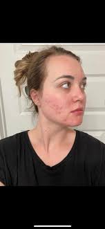 Not sure if it's been said before but the skin virus drops work wonders